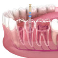 Which Tooth Most Frequently Requires Endodontic Treatment?