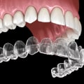 Why is Invisalign More Expensive than Other Orthodontic Treatments?