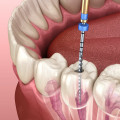 Which Type of Dentist is Best for Root Canal Treatment?