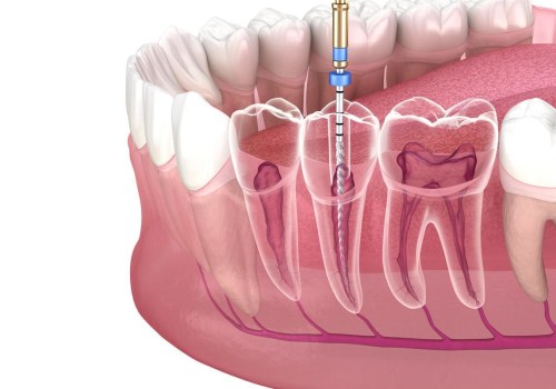 Which Tooth Most Frequently Requires Endodontic Treatment?