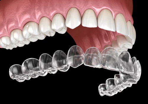 Why is Invisalign More Expensive than Other Orthodontic Treatments?