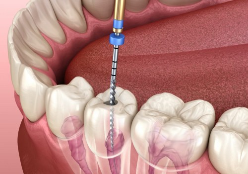 Which Type of Dentist is Best for Root Canal Treatment?